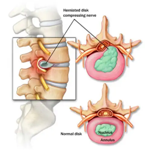 جراحی دیسک بیرون زده