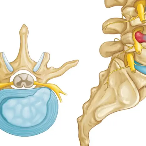 جراحی دیسک کمر l2 l3