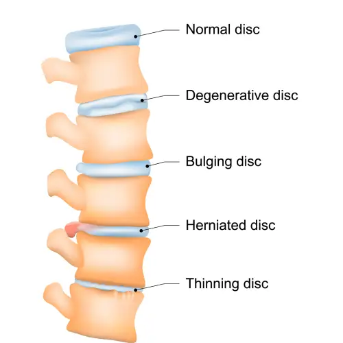 درمان برجستگی دیسک کمر