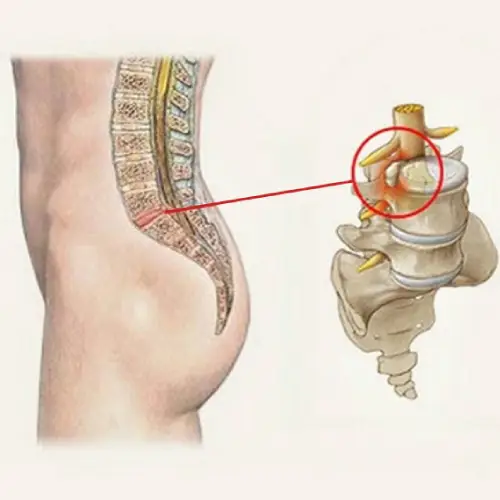 درمان برجستگی دیسک کمر