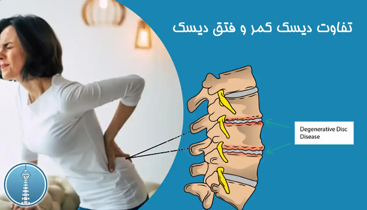 دیسک کمر و فتق دیسک