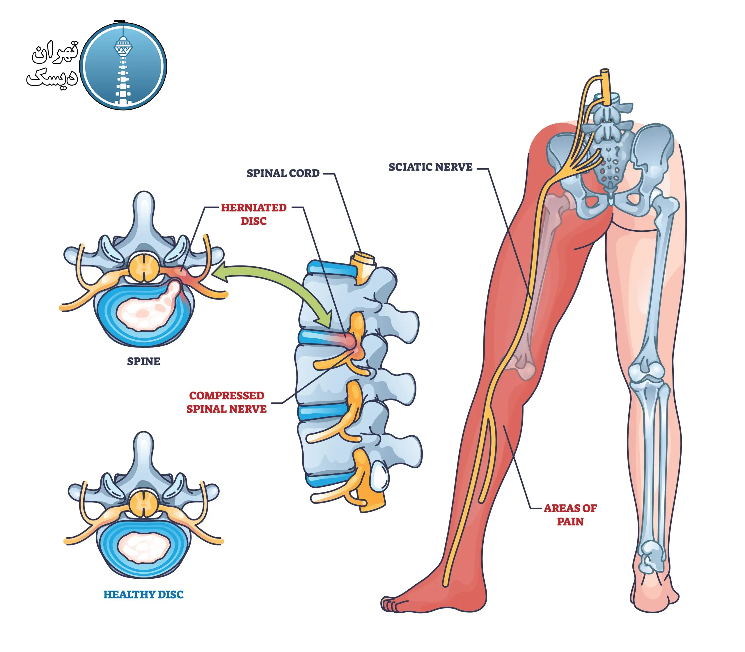 رابطه دیسک کمر و سیاتیک