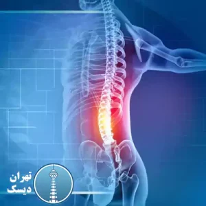 مشکلات دیسک کمر چیست؟