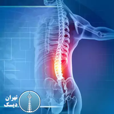 مشکلات دیسک کمر چیست؟