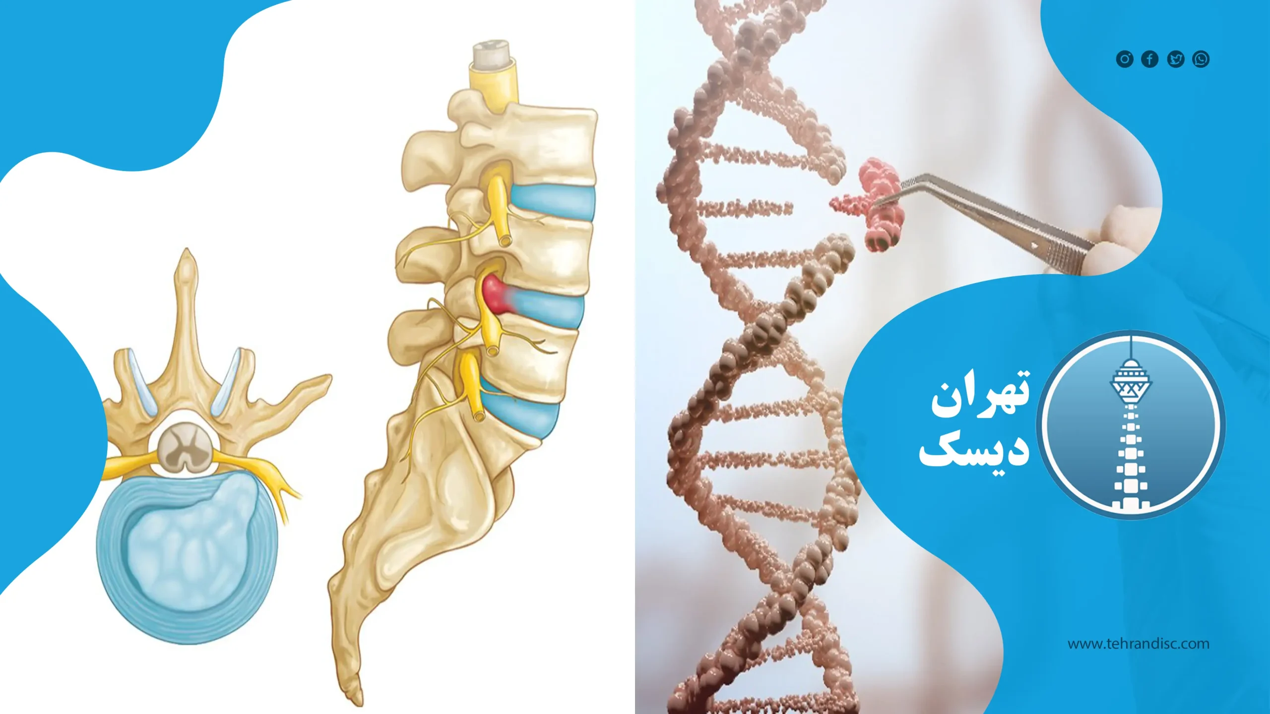 نقش ژنتیک در ابتلا به دیسک کمر تهران دیسک